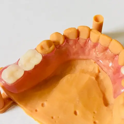 Denture and framework example 2 Chrome Cast Dental Laboratory East Sussex