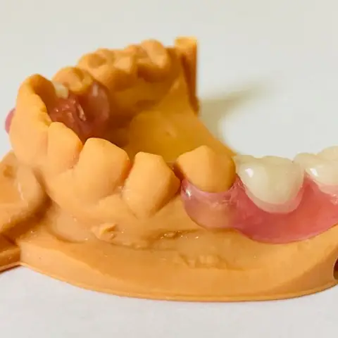 Denture and framework example 3 Chrome Cast Dental Laboratory East Sussex