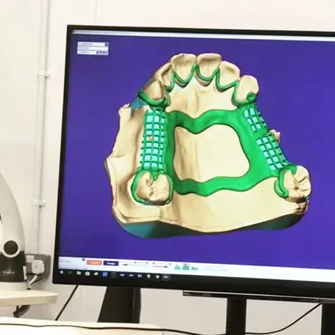 Denture and framework example 4 Chrome Cast Dental Laboratory East Sussex