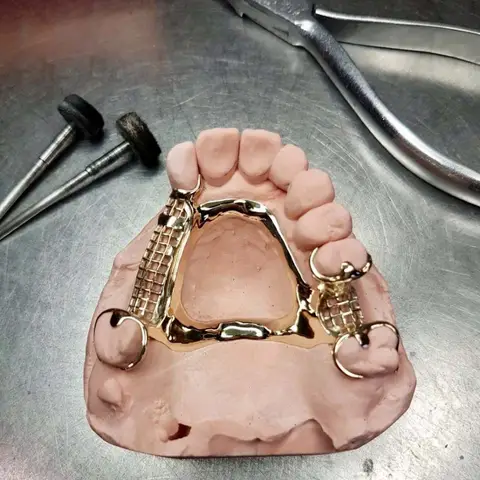 Denture and framework example 5 Chrome Cast Dental Laboratory East Sussex