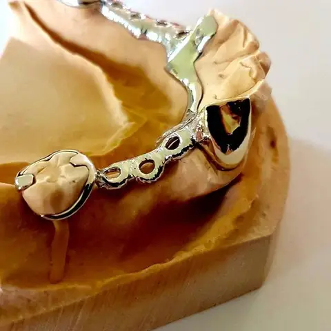 Denture and framework example 9 Chrome Cast Dental Laboratory East Sussex