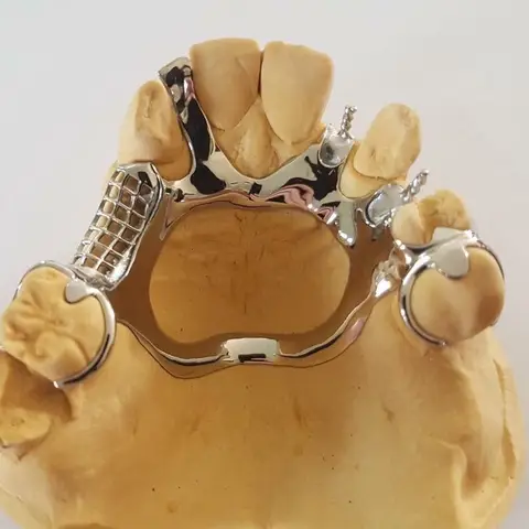 Denture and framework example 11 Chrome Cast Dental Laboratory East Sussex
