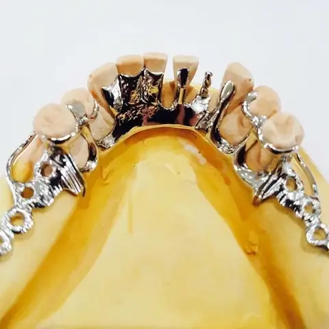 Denture and framework example 13 Chrome Cast Dental Laboratory East Sussex
