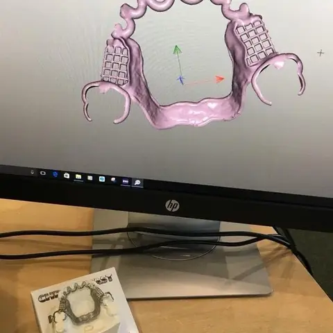 Denture and framework example 21 Chrome Cast Dental Laboratory East Sussex