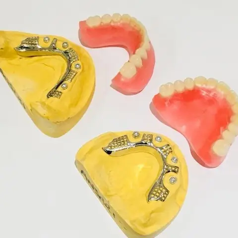 Denture and framework example 30 Chrome Cast Dental Laboratory East Sussex