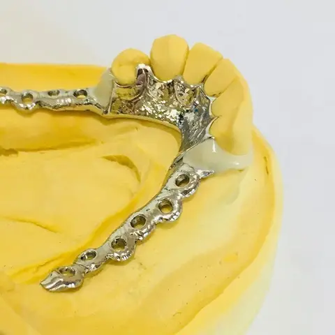 Denture and framework example 35 Chrome Cast Dental Laboratory East Sussex