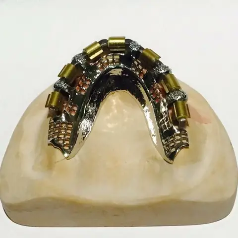 Denture and framework example 40 Chrome Cast Dental Laboratory East Sussex