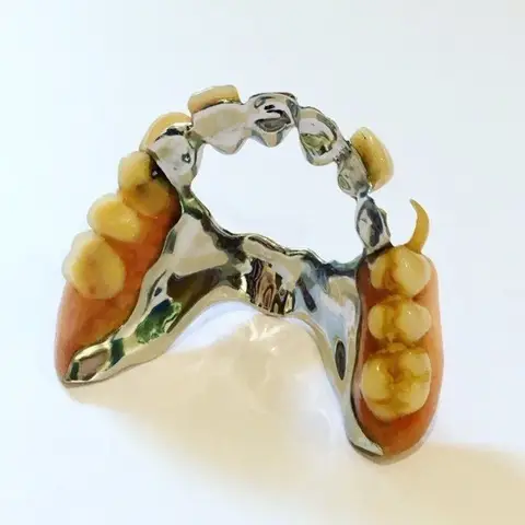 Denture and framework example 41 Chrome Cast Dental Laboratory East Sussex