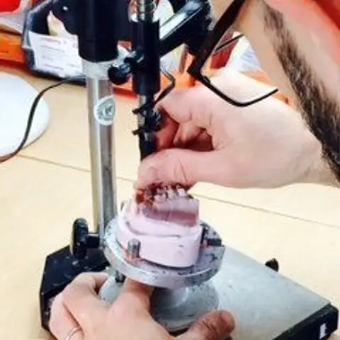 Denture and framework example 43 Chrome Cast Dental Laboratory East Sussex