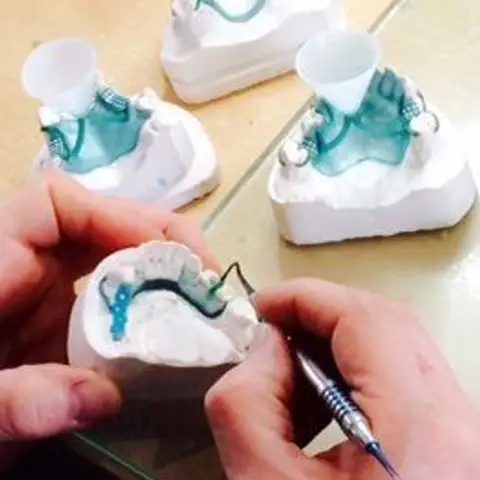Denture and framework example 44 Chrome Cast Dental Laboratory East Sussex