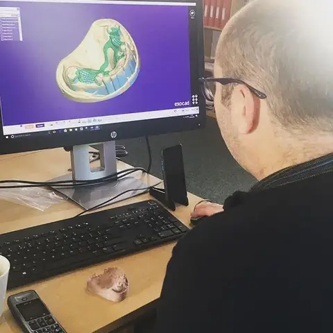 Denture and framework example 48 Chrome Cast Dental Laboratory East Sussex