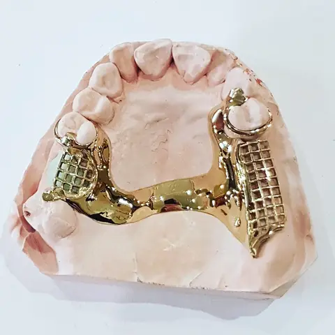 Denture and framework example 55 Chrome Cast Dental Laboratory East Sussex