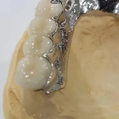 Denture and framework example 56 Chrome Cast Dental Laboratory East Sussex