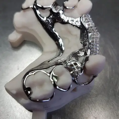 Denture and framework example 57 Chrome Cast Dental Laboratory East Sussex
