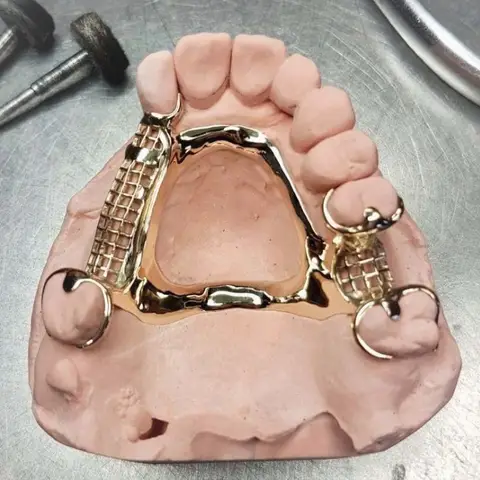 Denture and framework example 58 Chrome Cast Dental Laboratory East Sussex