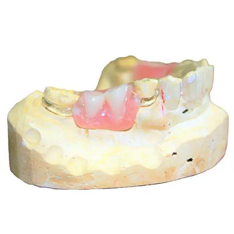 Denture and framework example 59 Chrome Cast Dental Laboratory East Sussex