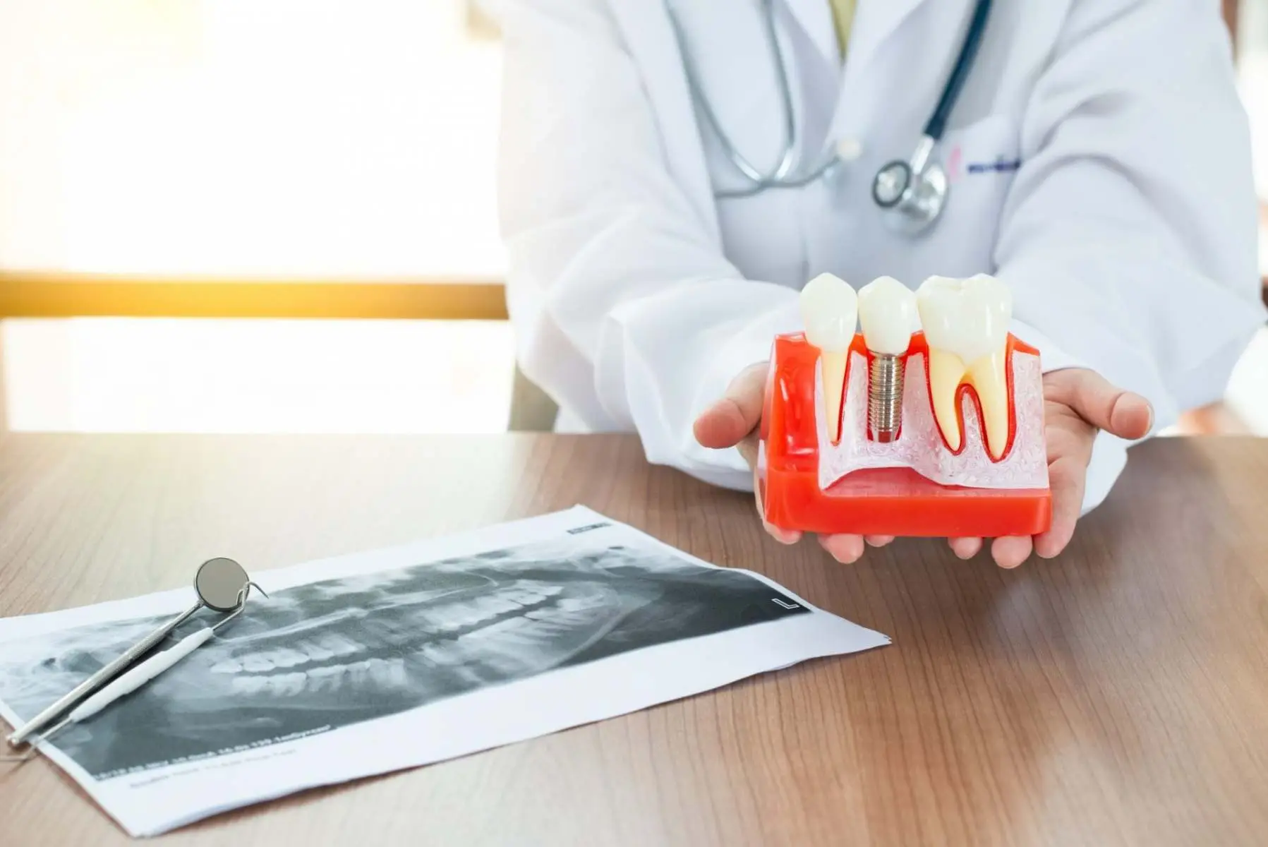 Dentist holding a dental implant model Chrome Cast denture services East Sussex