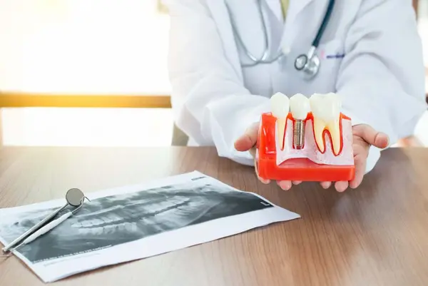 Dental implant model for implant retained frameworks Chrome Cast