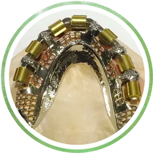 Attachments and Implants Chrome Cast Dental Laboratory East Sussex