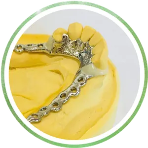 Tooth Coloured Resin Clasps Chrome Cast Dental Laboratory East Sussex