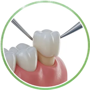 Zirconia Crowns Chrome Cast Dental Laboratory East Sussex